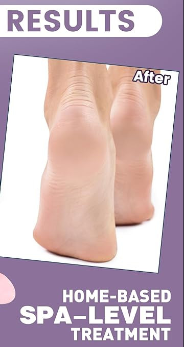 Before and after comparison of feet with a home-based spa-level treatment product on a purple background.